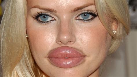 worst plastic surgery faces